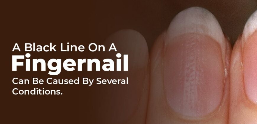 Black Lines On Nails – Reasons And Should You Worry About It? - Healthy ...