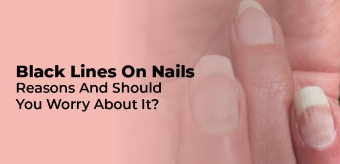 Black Lines On Nails – Reasons And Should You Worry About It? - Healthy ...